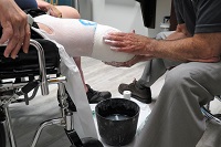 Image of an interim prosthetic leg being fitted